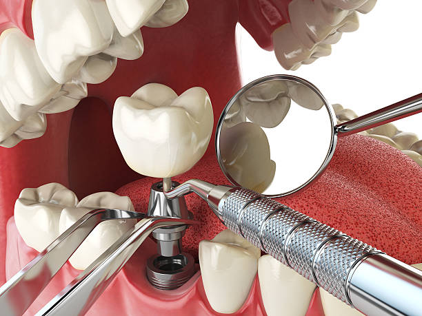 Best Emergency Wisdom Tooth Extraction in Five Points, OH